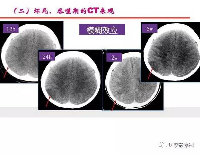 【PPT】脑梗塞影像学诊断