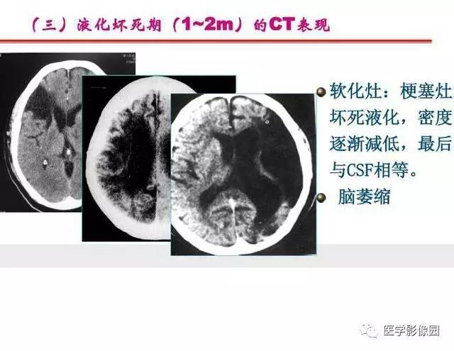 【PPT】脑梗塞影像学诊断