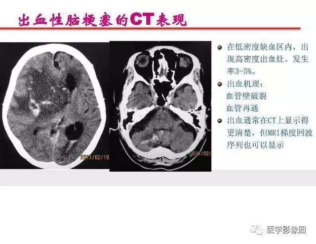【PPT】脑梗塞影像学诊断