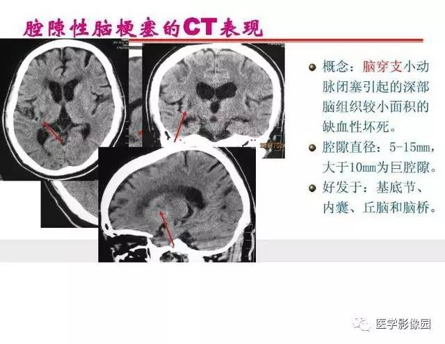 【PPT】脑梗塞影像学诊断