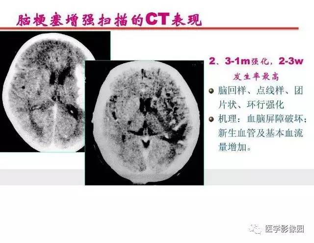 【PPT】脑梗塞影像学诊断