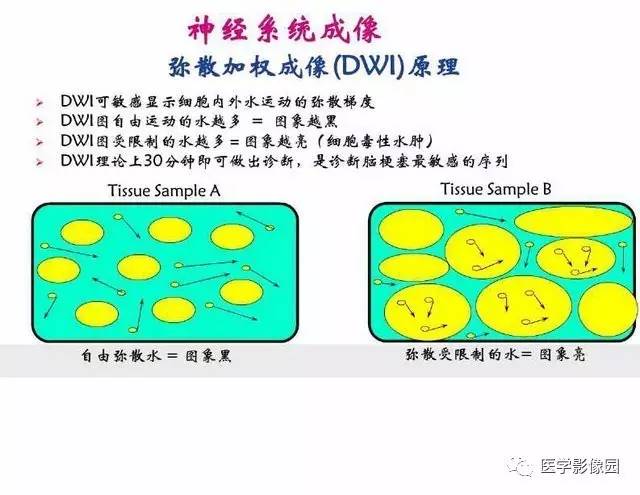 【PPT】脑梗塞影像学诊断