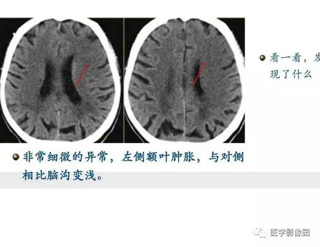 【PPT】脑梗塞影像学诊断
