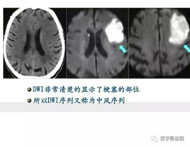 【PPT】脑梗塞影像学诊断