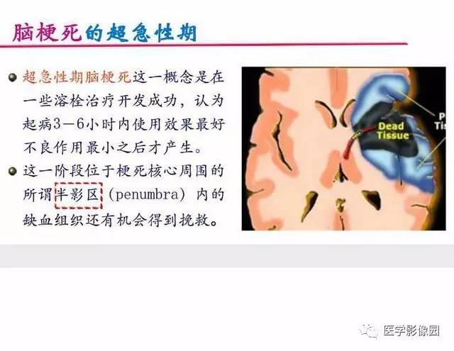 【PPT】脑梗塞影像学诊断