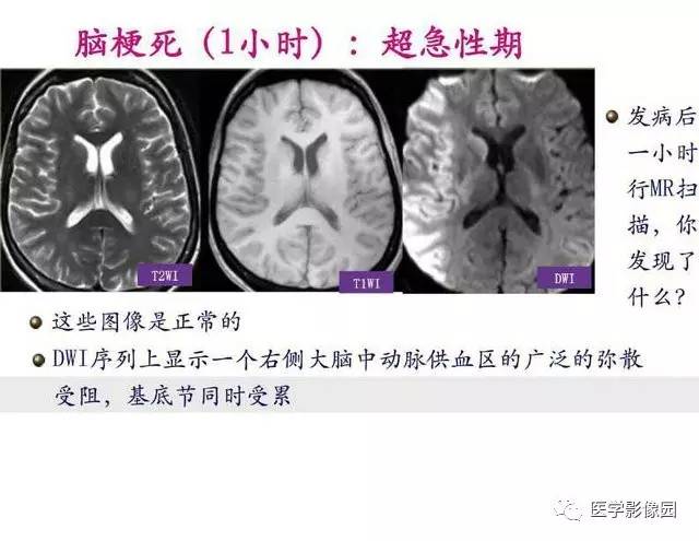 【PPT】脑梗塞影像学诊断