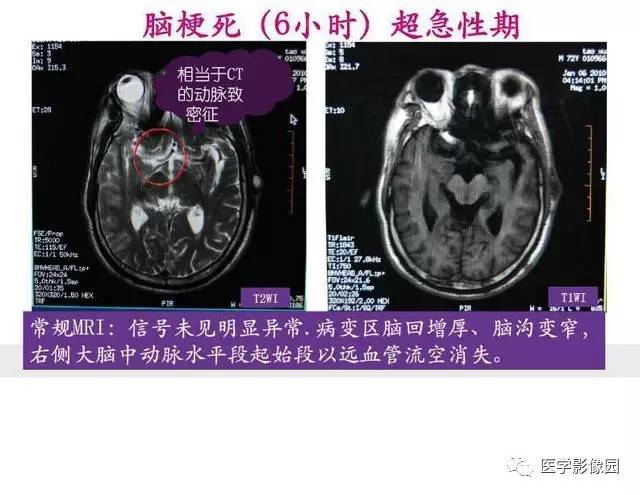 【PPT】脑梗塞影像学诊断