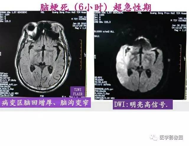 【PPT】脑梗塞影像学诊断