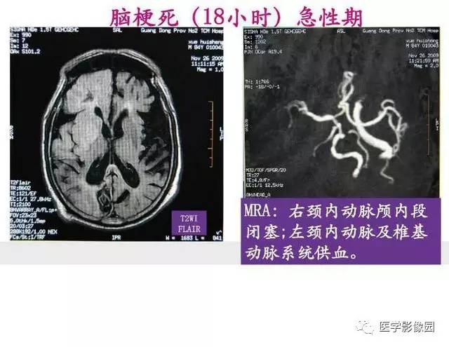 【PPT】脑梗塞影像学诊断