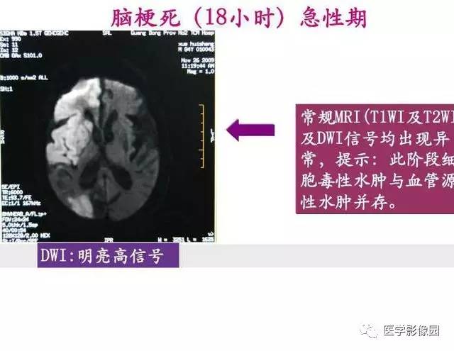 【PPT】脑梗塞影像学诊断
