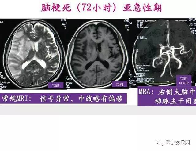 【PPT】脑梗塞影像学诊断
