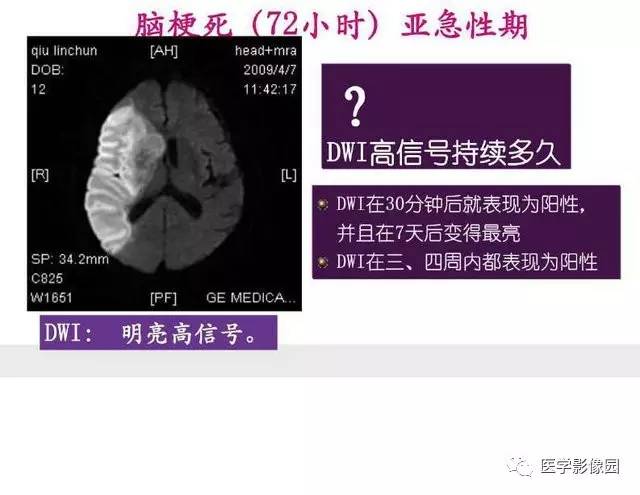 【PPT】脑梗塞影像学诊断