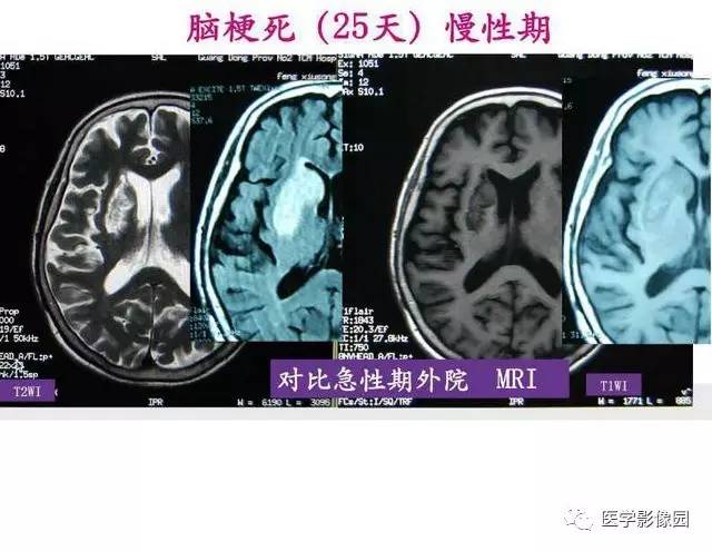 【PPT】脑梗塞影像学诊断