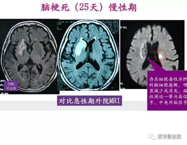 【PPT】脑梗塞影像学诊断