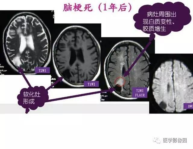 【PPT】脑梗塞影像学诊断
