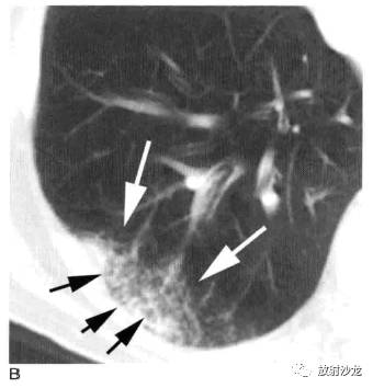 肺实变的影像学表现 肺实变的影像学表现