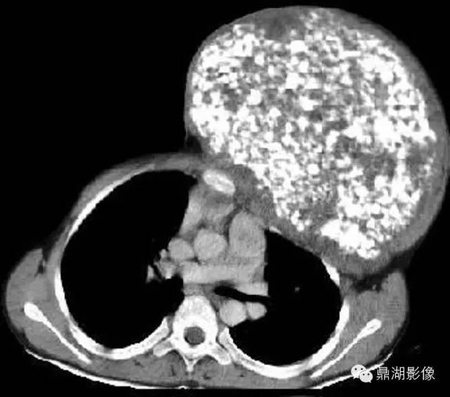 【病例】左侧胸壁软骨肉瘤1例CT影像表现