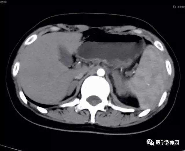 【病例】双肾上腺结核合并腹膜后结核干酪样坏死1例CT 【病例】双肾上腺结核合并腹膜后结核干酪样坏死1例CT