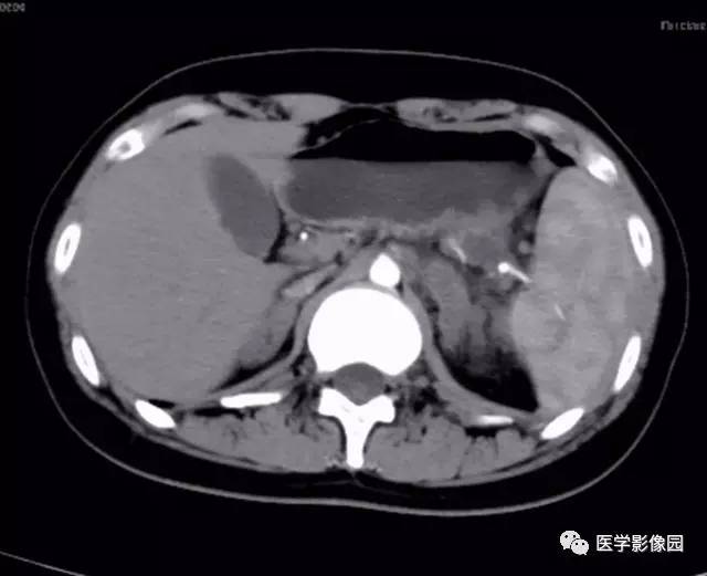 【病例】双肾上腺结核合并腹膜后结核干酪样坏死1例CT 【病例】双肾上腺结核合并腹膜后结核干酪样坏死1例CT