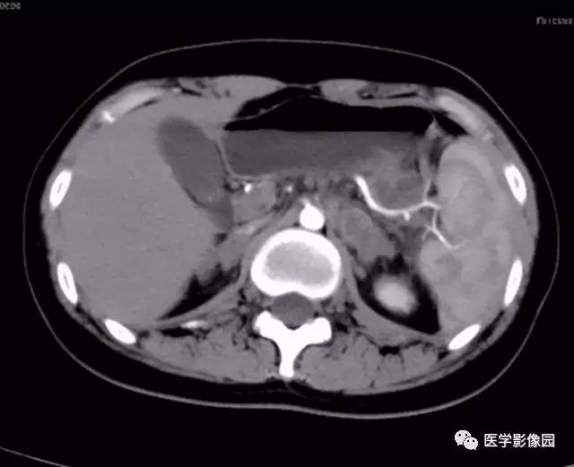 【病例】双肾上腺结核合并腹膜后结核干酪样坏死1例CT