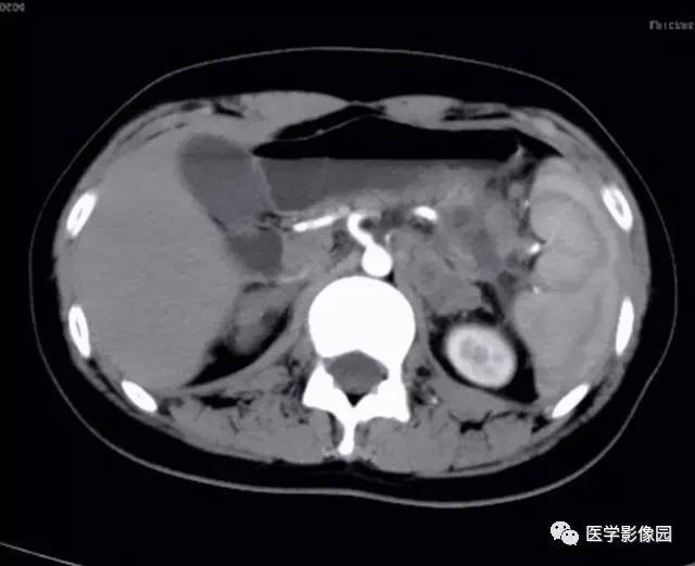 【病例】双肾上腺结核合并腹膜后结核干酪样坏死1例CT 【病例】双肾上腺结核合并腹膜后结核干酪样坏死1例CT