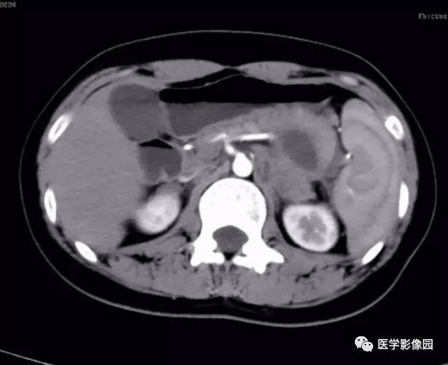 【病例】双肾上腺结核合并腹膜后结核干酪样坏死1例CT 【病例】双肾上腺结核合并腹膜后结核干酪样坏死1例CT