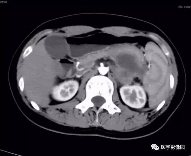 【病例】双肾上腺结核合并腹膜后结核干酪样坏死1例CT 【病例】双肾上腺结核合并腹膜后结核干酪样坏死1例CT