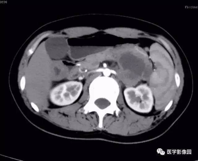 【病例】双肾上腺结核合并腹膜后结核干酪样坏死1例CT 【病例】双肾上腺结核合并腹膜后结核干酪样坏死1例CT