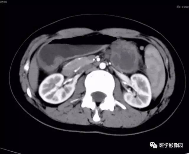 【病例】双肾上腺结核合并腹膜后结核干酪样坏死1例CT 【病例】双肾上腺结核合并腹膜后结核干酪样坏死1例CT