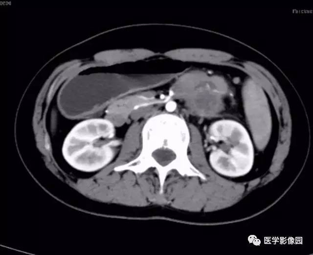 【病例】双肾上腺结核合并腹膜后结核干酪样坏死1例CT 【病例】双肾上腺结核合并腹膜后结核干酪样坏死1例CT
