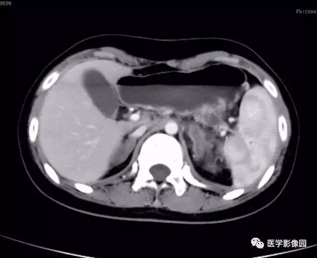 【病例】双肾上腺结核合并腹膜后结核干酪样坏死1例CT 【病例】双肾上腺结核合并腹膜后结核干酪样坏死1例CT