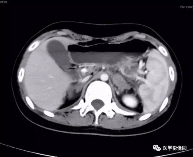 【病例】双肾上腺结核合并腹膜后结核干酪样坏死1例CT 【病例】双肾上腺结核合并腹膜后结核干酪样坏死1例CT