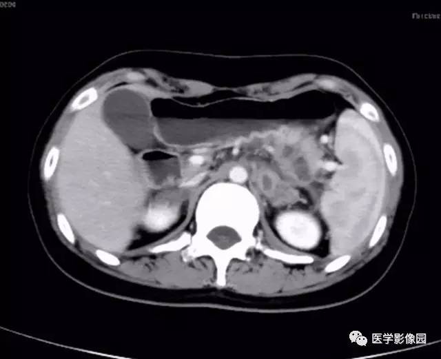 【病例】双肾上腺结核合并腹膜后结核干酪样坏死1例CT 【病例】双肾上腺结核合并腹膜后结核干酪样坏死1例CT
