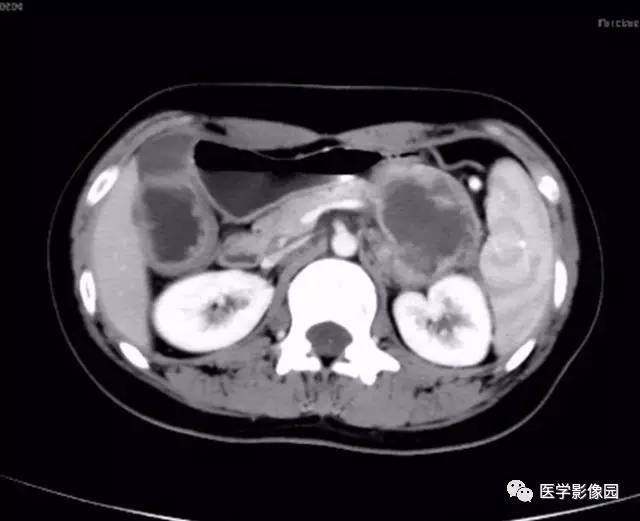 【病例】双肾上腺结核合并腹膜后结核干酪样坏死1例CT 【病例】双肾上腺结核合并腹膜后结核干酪样坏死1例CT