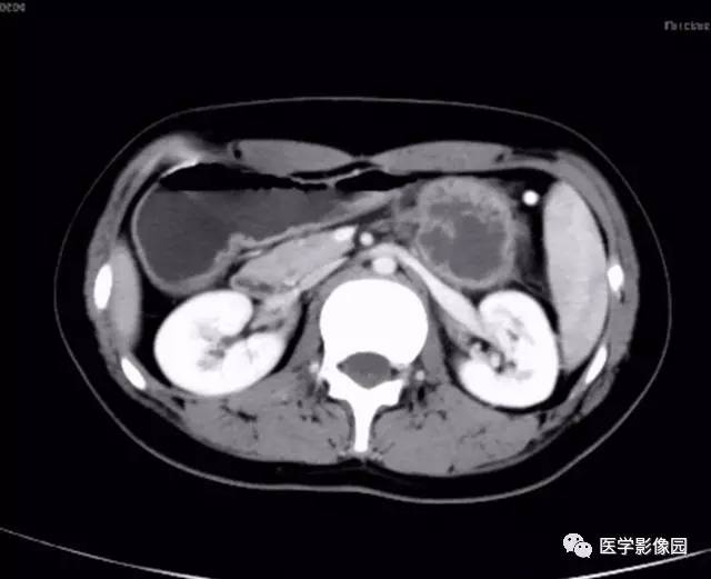 【病例】双肾上腺结核合并腹膜后结核干酪样坏死1例CT 【病例】双肾上腺结核合并腹膜后结核干酪样坏死1例CT