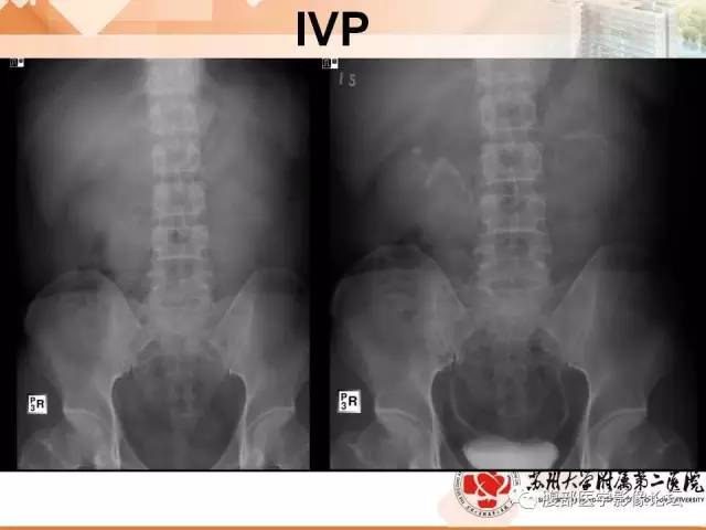 【病例】膀胱神经纤维瘤1例CT影像表现