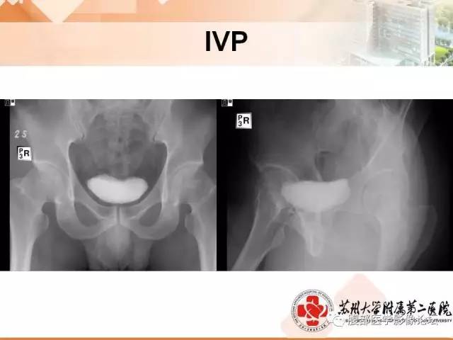 【病例】膀胱神经纤维瘤1例CT影像表现