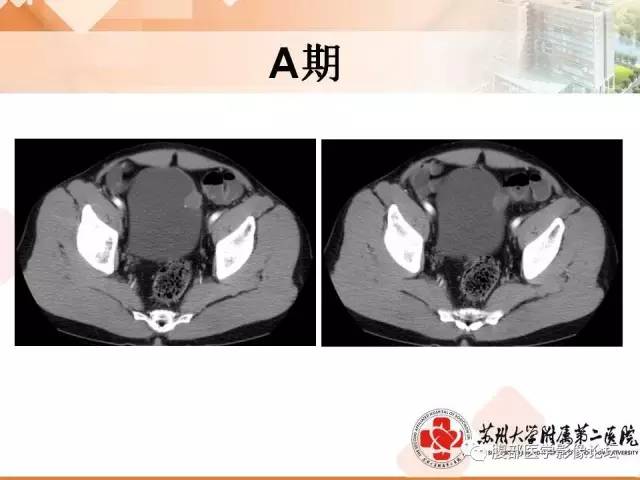 【病例】膀胱神经纤维瘤1例CT影像表现