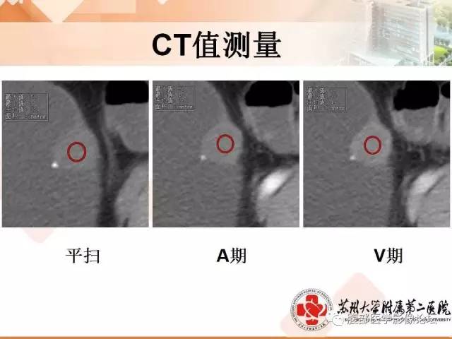 【病例】膀胱神经纤维瘤1例CT影像表现
