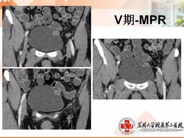 【病例】膀胱神经纤维瘤1例CT影像表现