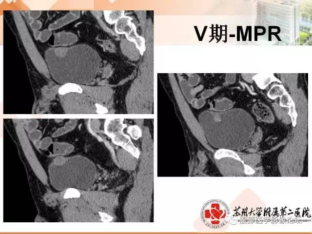 【病例】膀胱神经纤维瘤1例CT影像表现