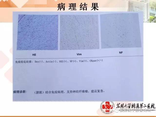 【病例】膀胱神经纤维瘤1例CT影像表现