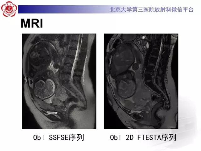 【病例】胎盘植入1例MR影像表现