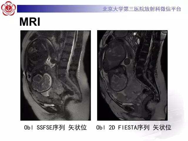 【病例】胎盘植入1例MR影像表现