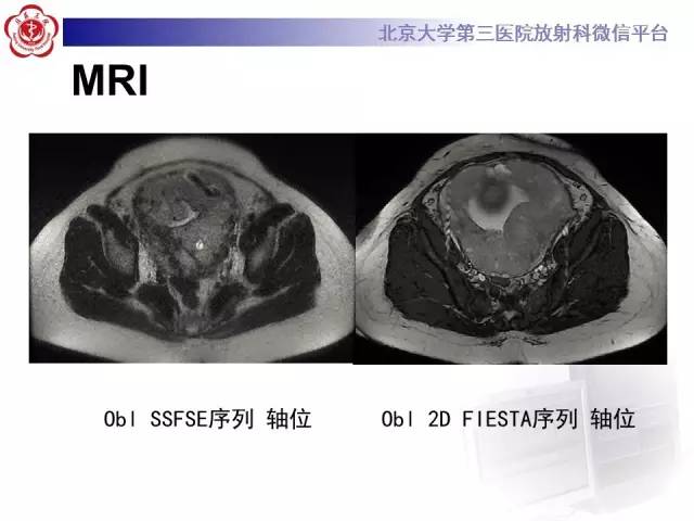 【病例】胎盘植入1例MR影像表现