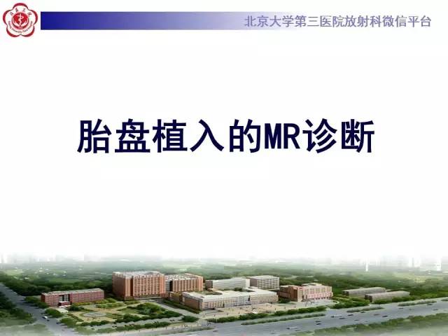 【病例】胎盘植入1例MR影像表现