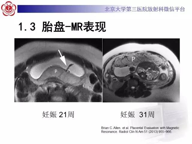 【病例】胎盘植入1例MR影像表现