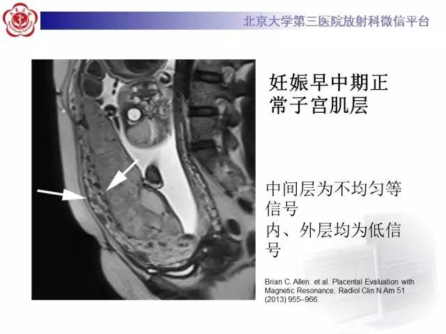 【病例】胎盘植入1例MR影像表现