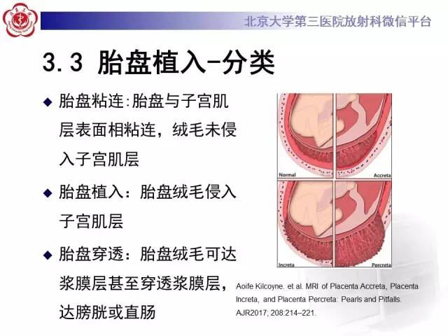 【病例】胎盘植入1例MR影像表现