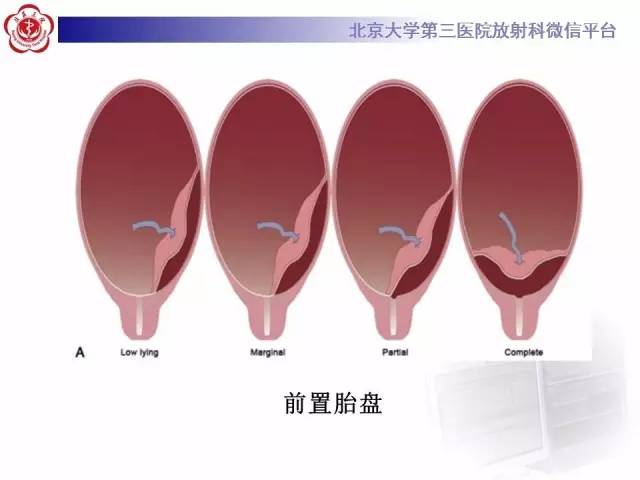 【病例】胎盘植入1例MR影像表现
